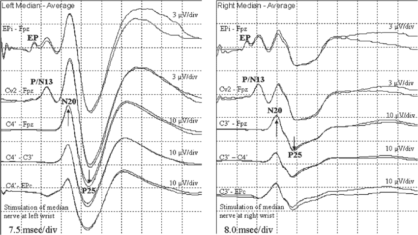 SSEP Monitoring: Understanding Somatosensory Evoked Potentials for Spinal Cord Protection 3 SSEP Monitoring